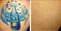 Eraser Clinic Laser Tattoo Removal image 4